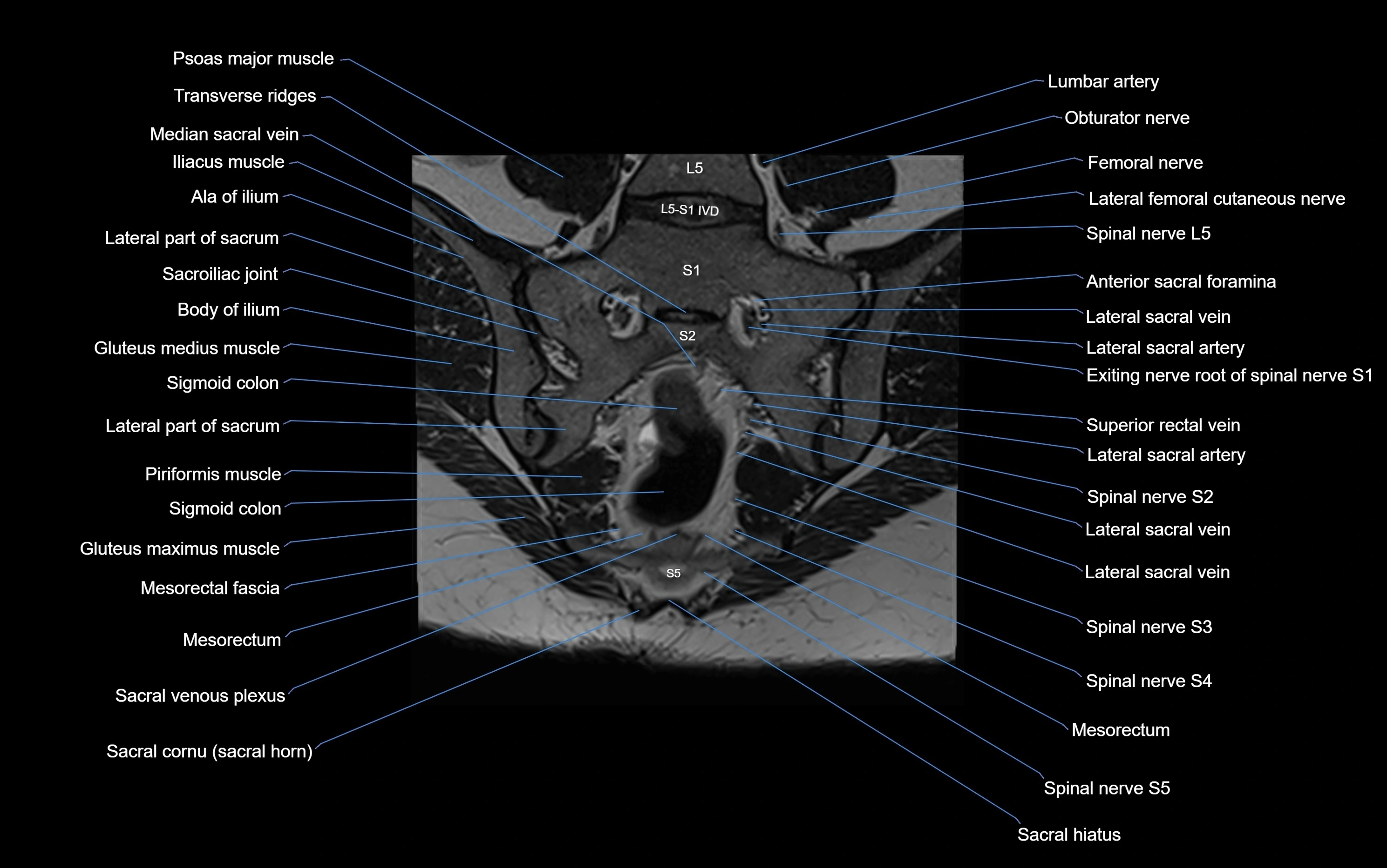 MRI sacroiliac joint coronal cross sectional anatomy  radiology  image-img-00001-00017.webp